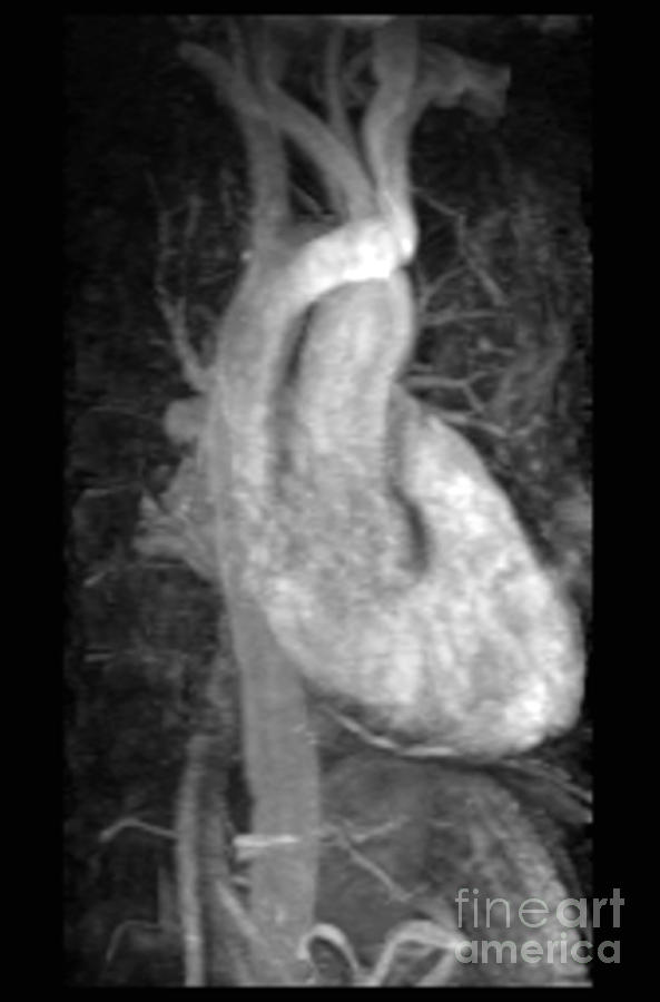 Magnetic Resonance Angiography Photograph - Mra, Normal Heart #1 by Living Art Enterprises