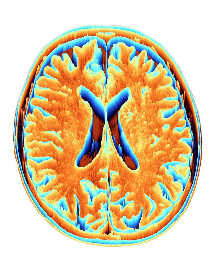 Мозг магнитное поле. Normal Cerebrum MRI. Normal Brain MRI. Colored MRI High Resolution.