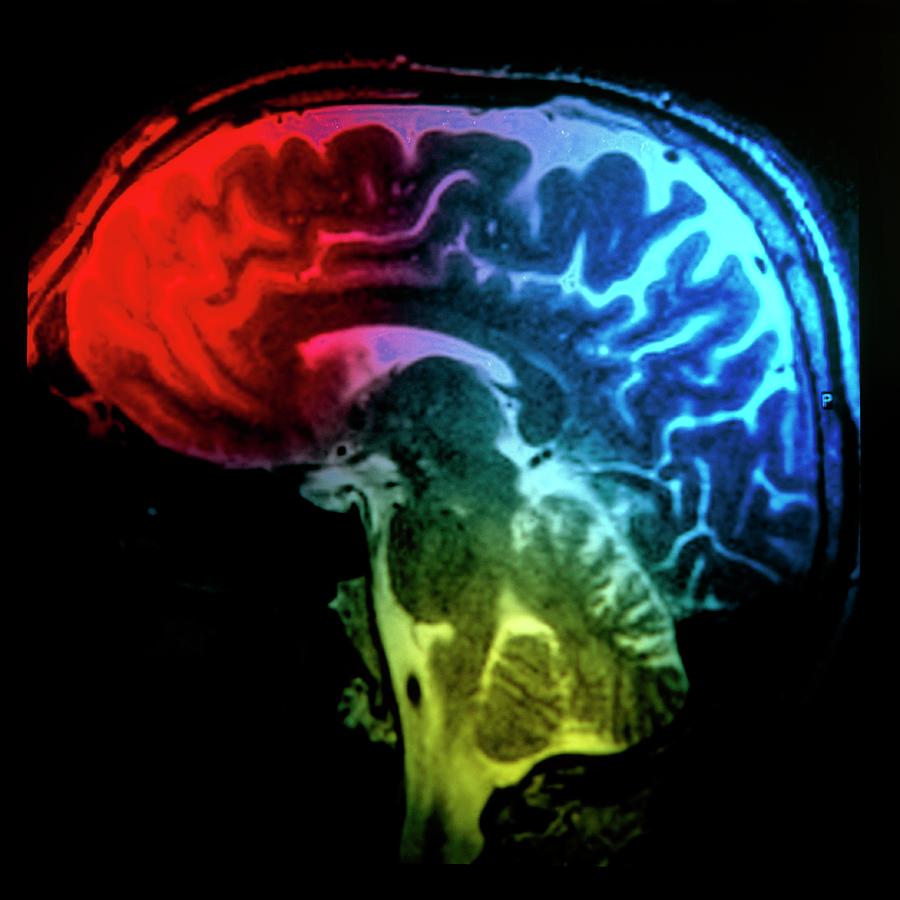 Mri Brain Scan #1 Photograph by Mark Thomas/science Photo Library