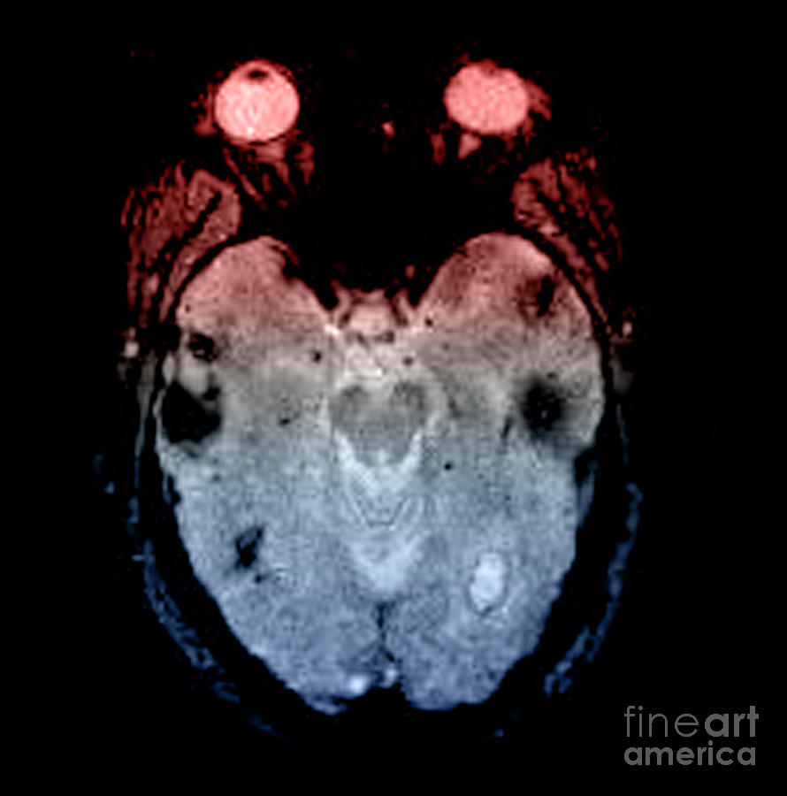 Mri Of Amyloid Angiopathy #1 Photograph by Living Art Enterprises