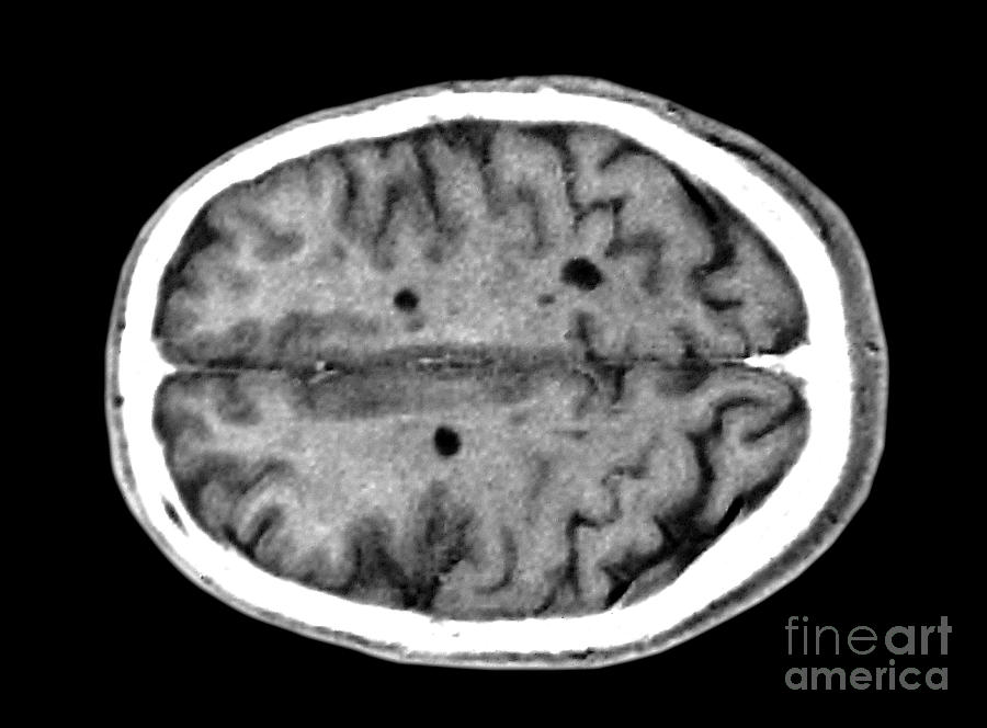 Multiple Sclerosis Brain Lesions #1 Photograph by Scott Camazine