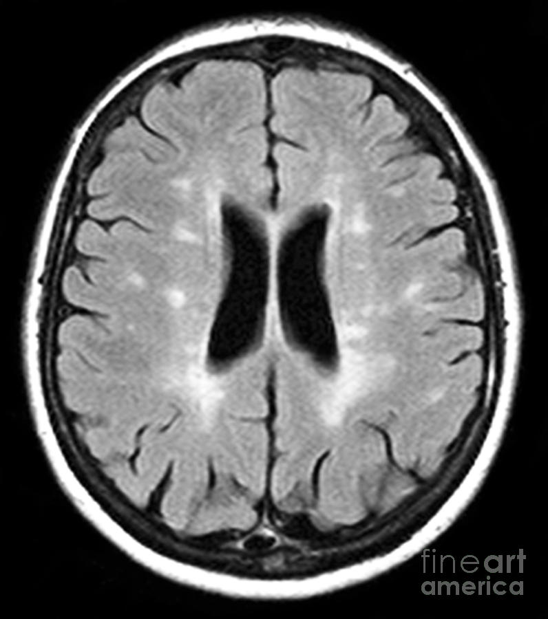 Multiple Sclerosis Mri Scan Photograph By Du Cane Medical Imaging Ltd