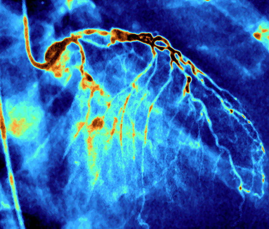 Narrowed Coronary Arteries Photograph by Zephyr/science Photo Library ...