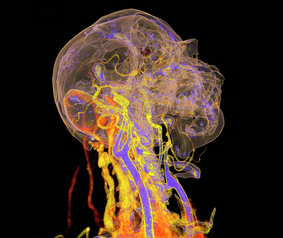 Neck Blood Vessels #1 Photograph by K H Fung/science Photo Library