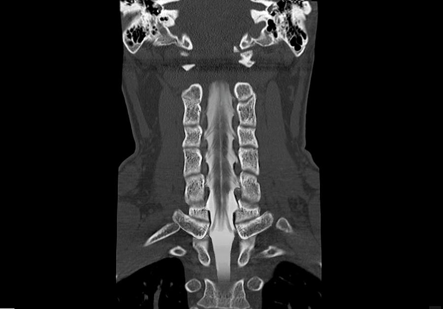 Neck Bones And Spinal Cord Photograph by Zephyr/science Photo Library ...