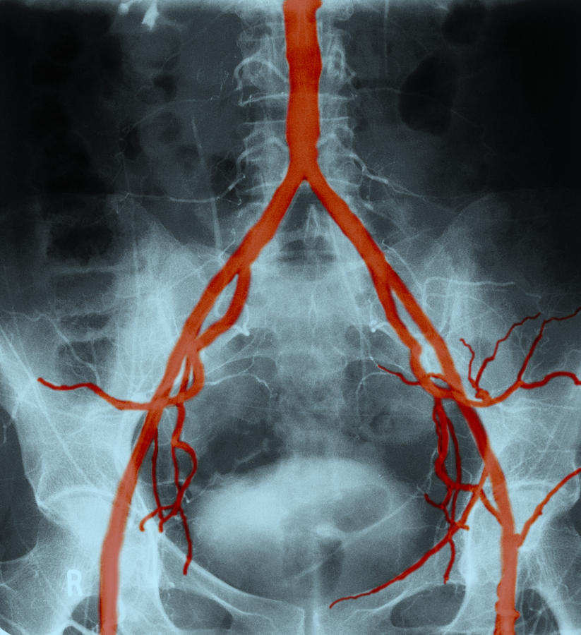 Normal Arteriogram #1 Photograph by John Watney