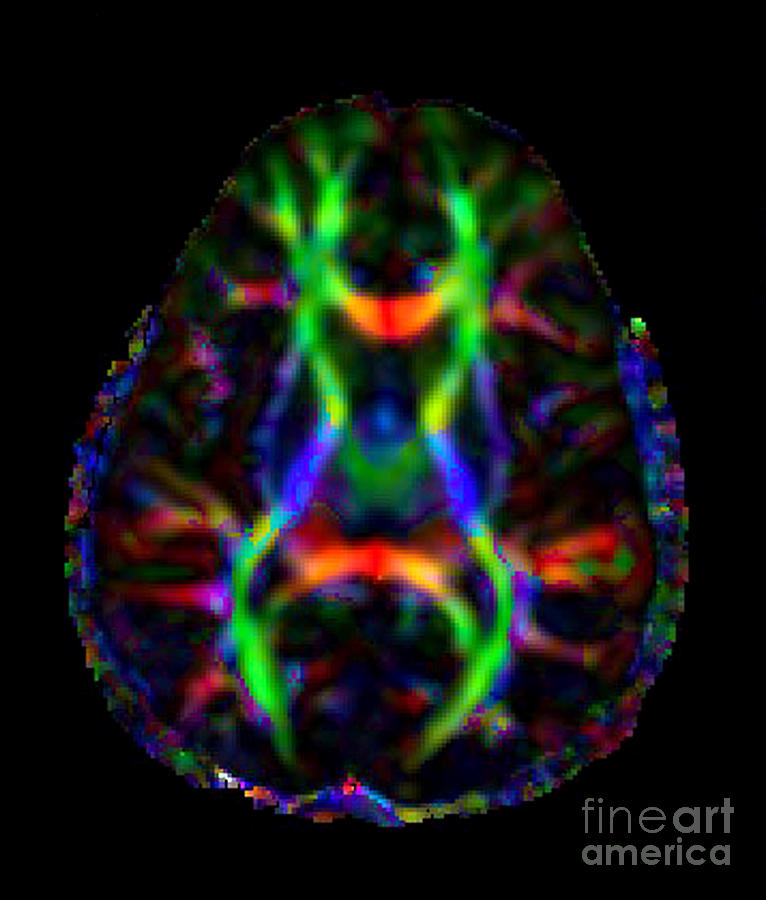 Normal Brain Diffusion Tractography #1 Photograph by Living Art Enterprises