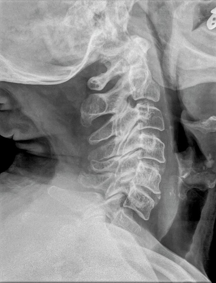 x rays of cervical spine