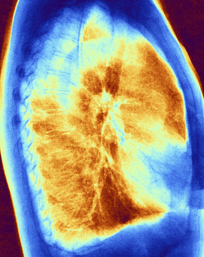 Normal chest coloured x-ray Photograph by Science Photo Library - Pixels