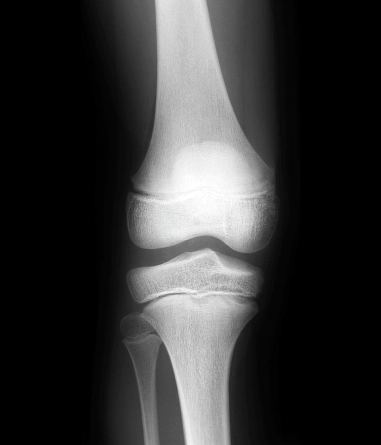 normal knee xray