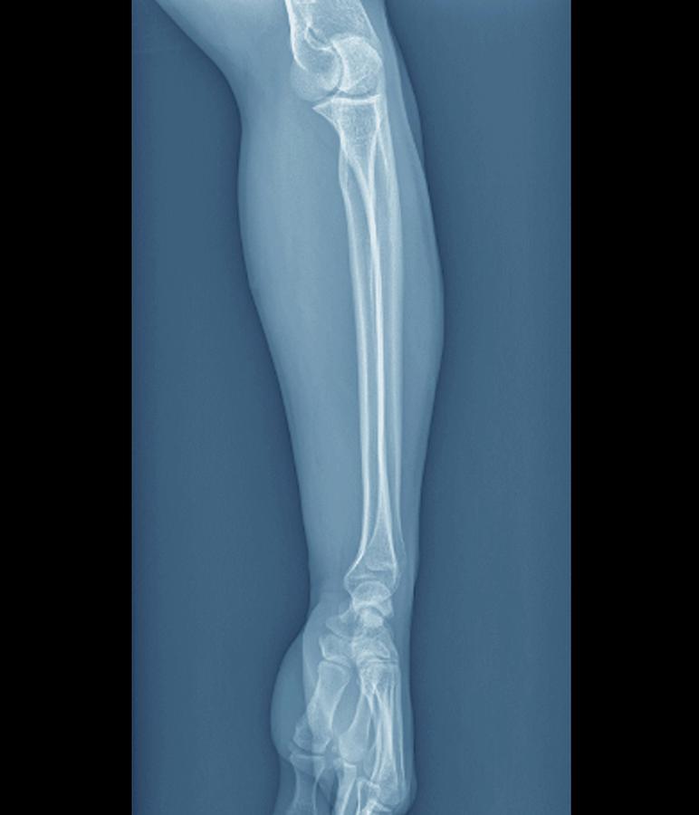 Normal Elbow And Wrist Joints Photograph by Zephyr/science Photo Library