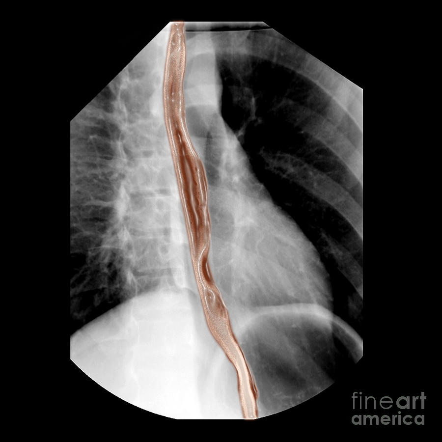 Diagnostic Imaging Photograph - Normal Esophagus #1 by Living Art Enterprises