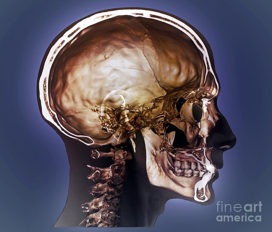 normal neck ct scan