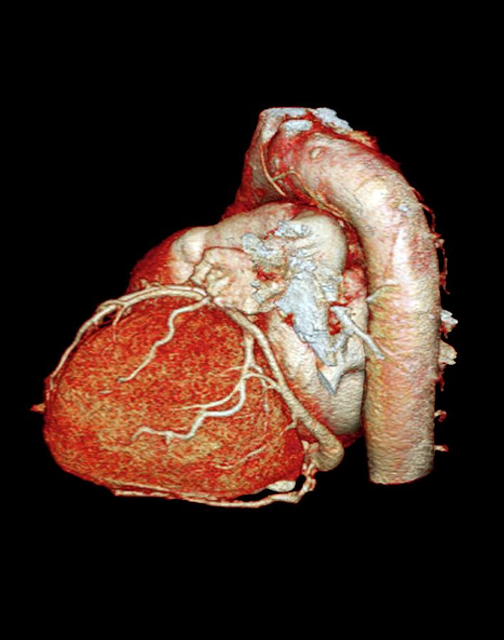 Normal Heart #1 Photograph by Zephyr/science Photo Library