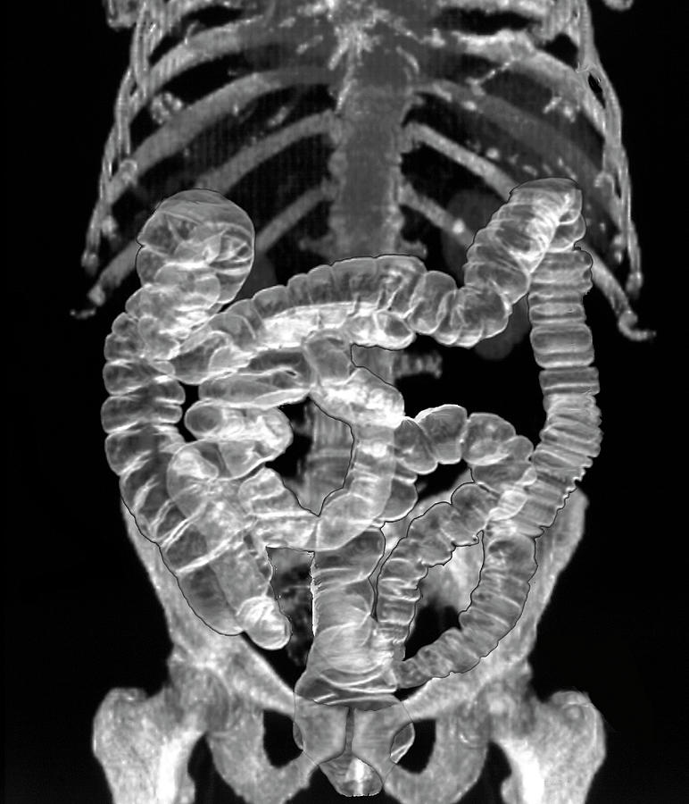 Intestine Photograph - Normal Intestines #1 by Zephyr/science Photo Library