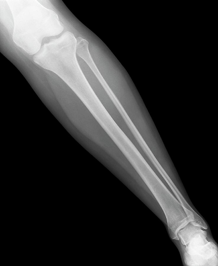 Normal Lower Leg #1 by Zephyr/science Photo Library
