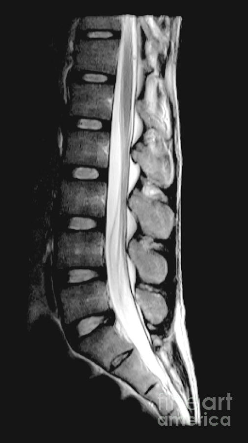 Normal Lumbar Spine, Mri #1 Photograph by Living Art Enterprises