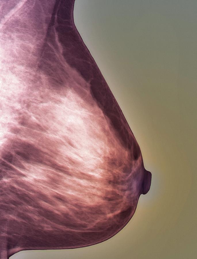 Radiological Photograph - Normal Mammogram #1 by Zephyr/science Photo Library
