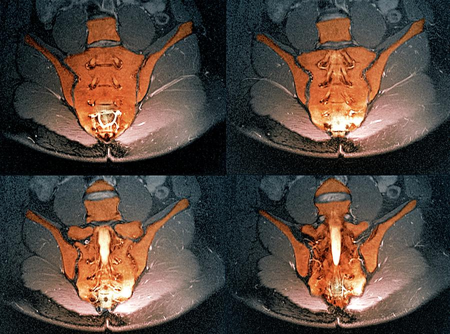 Normal Sacrum #1 by Science Photo Library