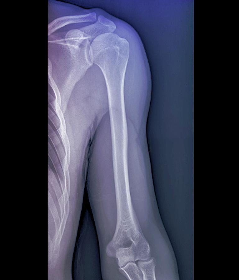 Elbow Photograph - Normal Shoulder Joint #1 by Zephyr/science Photo Library