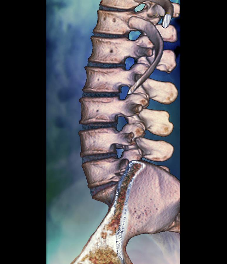 Normal Spine Photograph By Zephyr/science Photo Library - Pixels