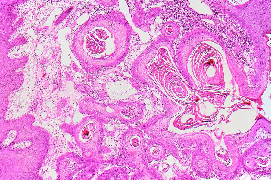 Disease Photograph - Oesophageal Cancer #1 by Antonio Romero
