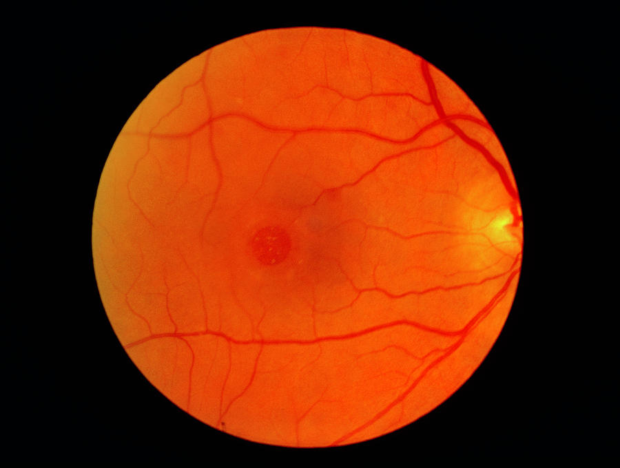Ophthalmoscope View Of Retina Showing Macula Hole #1 Photograph by Paul Parker/science Photo Library