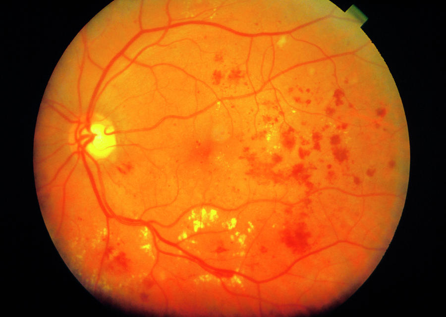 Ophthalmoscopy Of Eye With Diabetic Maculopathy #1 Photograph by Sue Ford/science Photo Library