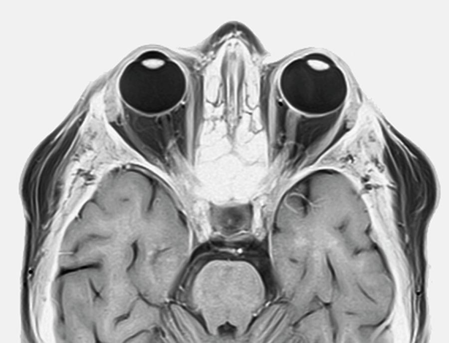 Optic Nerve Multiple Sclerosis Symptom Photograph By Zephyr science 