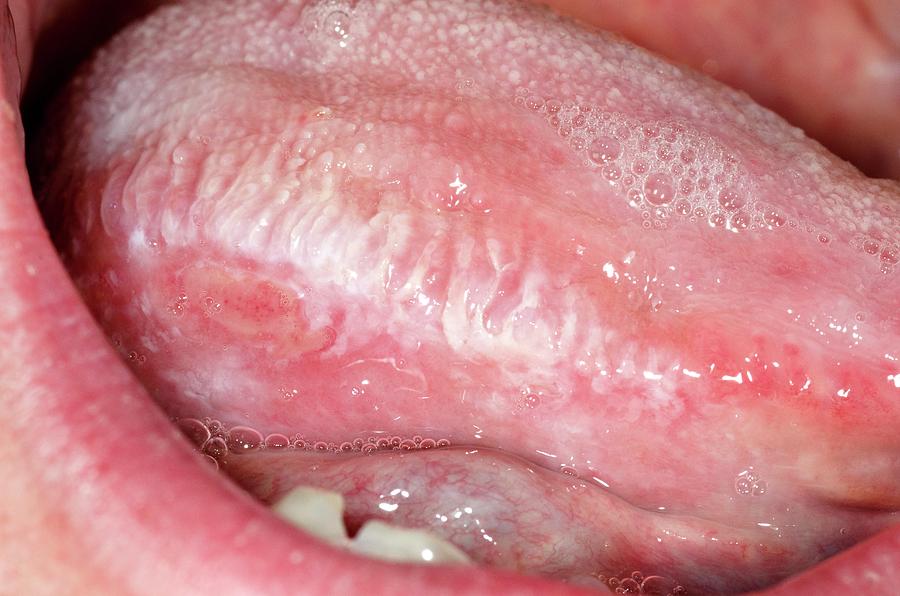 Oral Thrush Candidiasis Photograph By Dr P Marazzi Science Photo Library