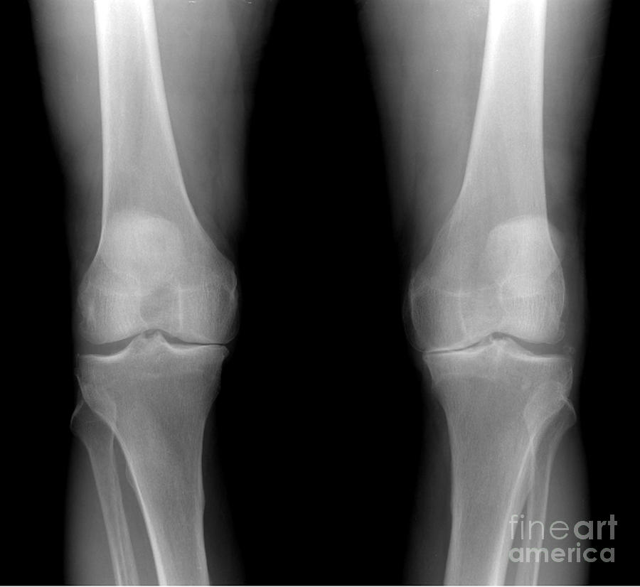 Osteoarthritis, Both Knees #1 Photograph by Living Art Enterprises