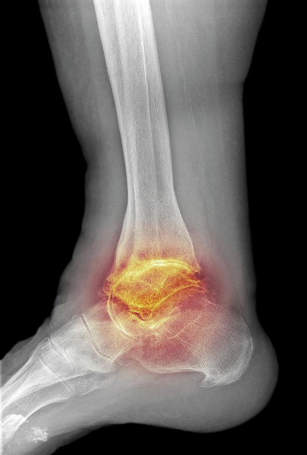 Osteoarthritis Of The Ankle Photograph By Science Photo Library Pixels