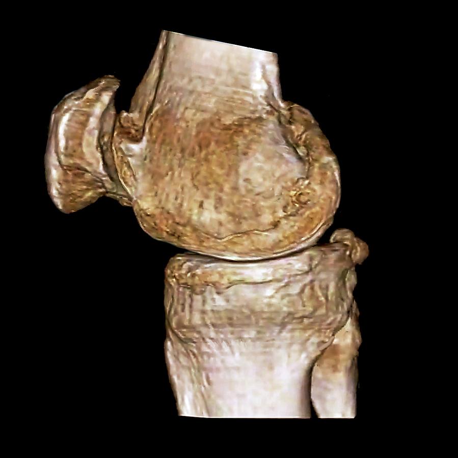 Osteoarthritis Of The Knee Photograph By Zephyrscience Photo Library