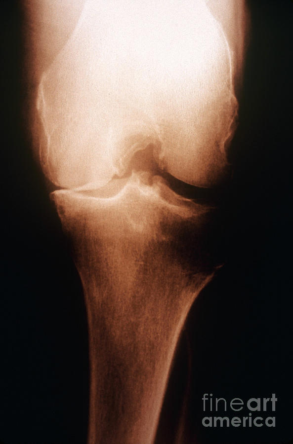 Osteoarthritis, X-ray #1 Photograph by Scott Camazine