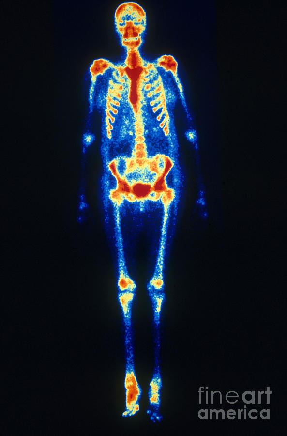 Osteomyelitis #1 Photograph by Scott Camazine