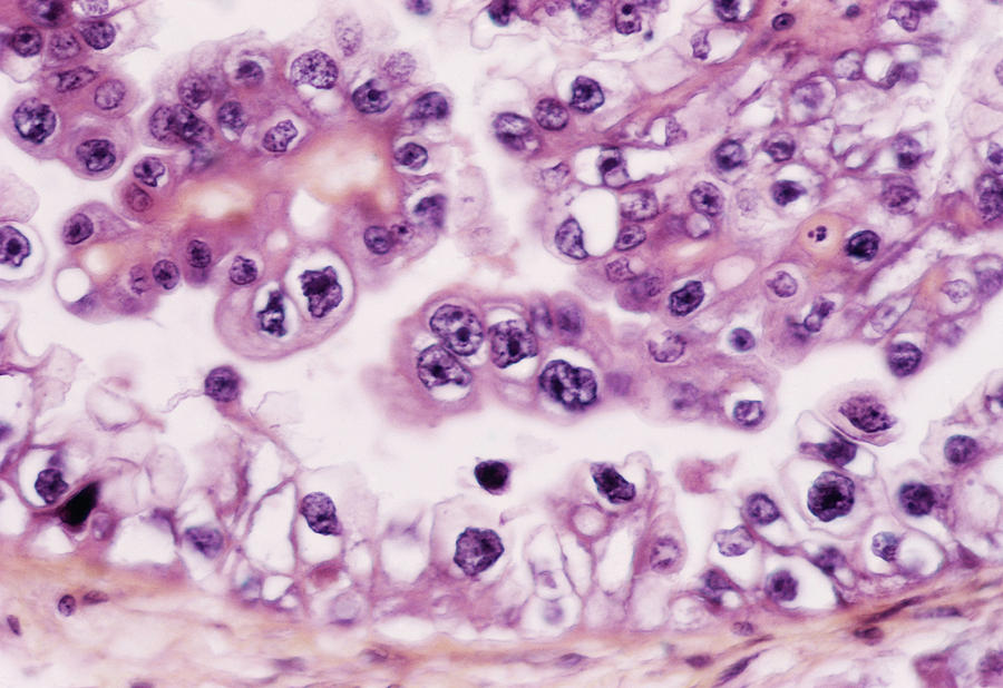 Ovarian Cancer #1 Photograph by Cnri/science Photo Library