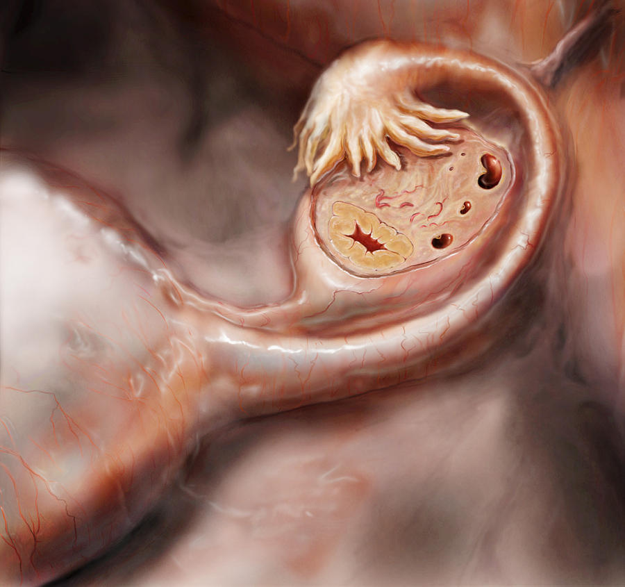 Ovary And Fallopian Tube #1 Photograph by Anatomical Travelogue