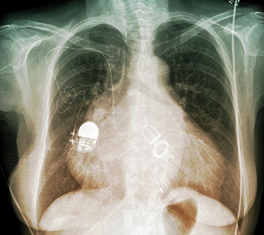 Pacemaker And Artificial Heart Valves #1 Photograph by Zephyr