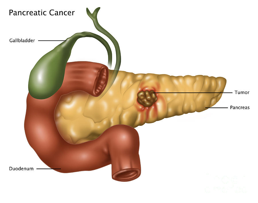 Pancreatic Cancer, Illustration #1 Photograph by Gwen Shockey