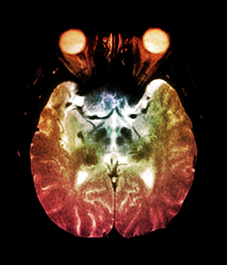 Parkinsons Disease Brain #1 Photograph by Zephyr/science Photo Library