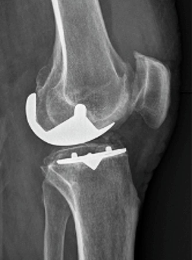 partial-knee-replacement-photograph-by-zephyr-fine-art-america