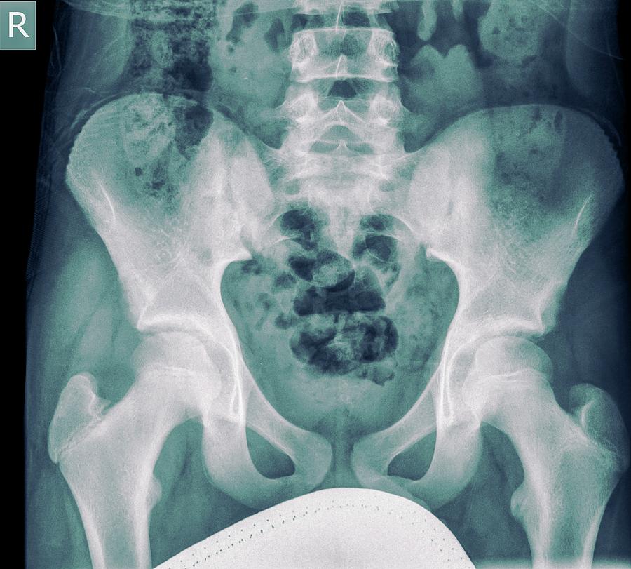 Skeleton Photograph - Pelvis X-ray #1 by Photostock-israel