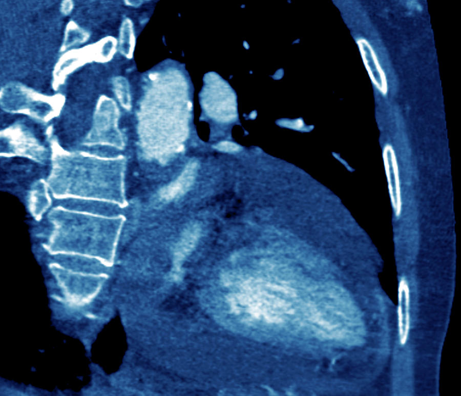 Pericardial Effusion Photograph By Zephyr/science Photo Library - Fine ...