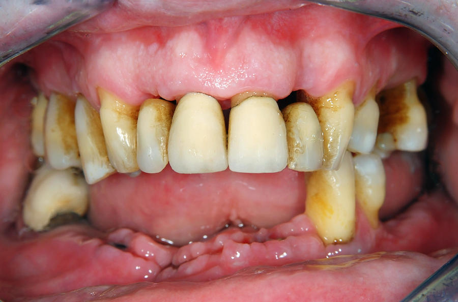 Periodontitis #1 Photograph by Danielzgombic