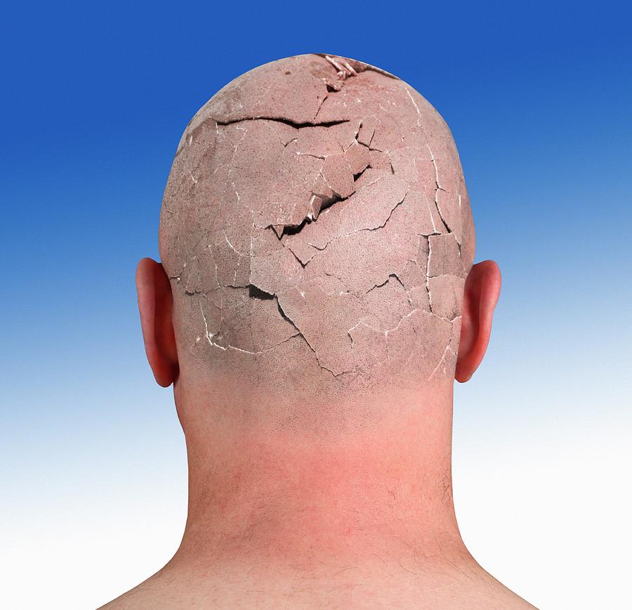Bald Photograph - Person With Cracked Head by Victor De Schwanberg/science ...