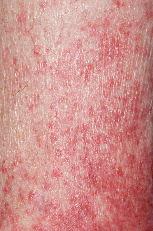 Petechial Rash Photograph by Dr P. Marazzi/science Photo Library