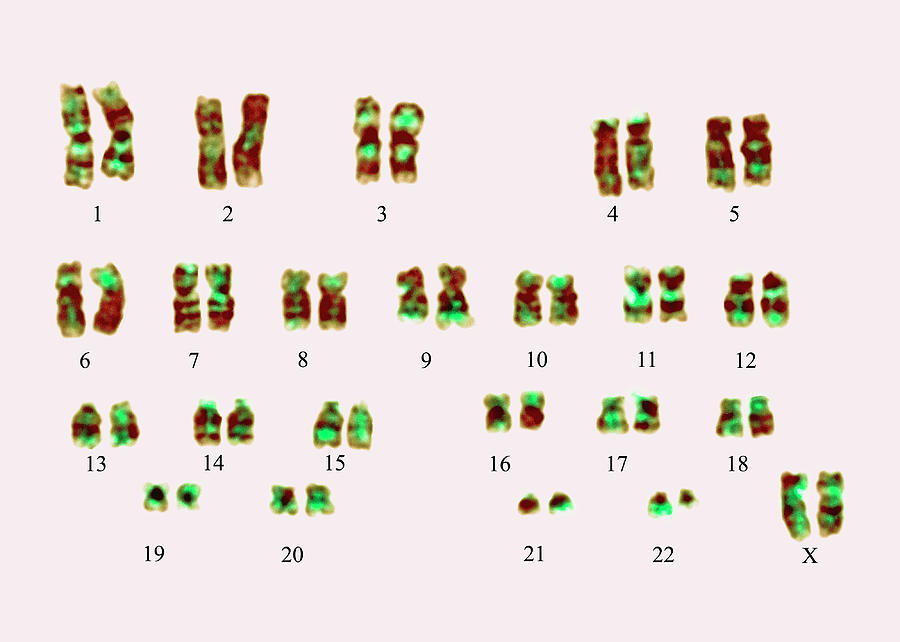 Philadelphia Chromosome #1 Photograph by Dept. Of Clinical Cytogenetics, Addenbrookes Hospital/science Photo Library