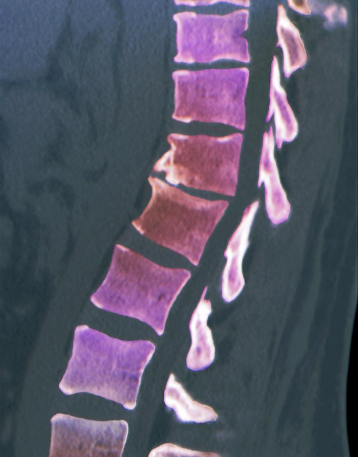 Pinched Vertebral Disc Of Spine Photograph by Zephyr/science Photo ...