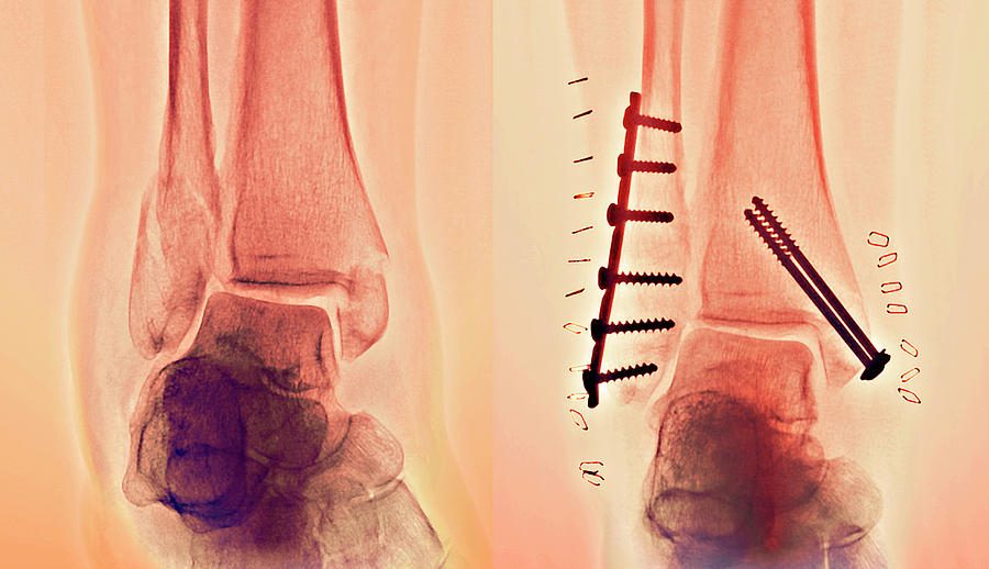 Pinned Ankle Fractures Photograph by Zephyr/science Photo Library