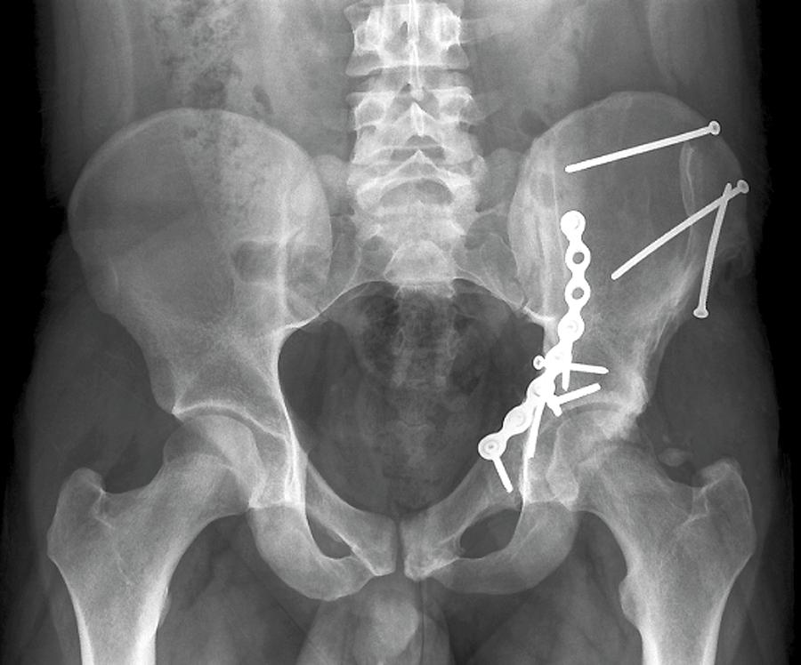 X-ray Photograph - pinned Hip Fractures #1 by Zephyr/science Photo Library